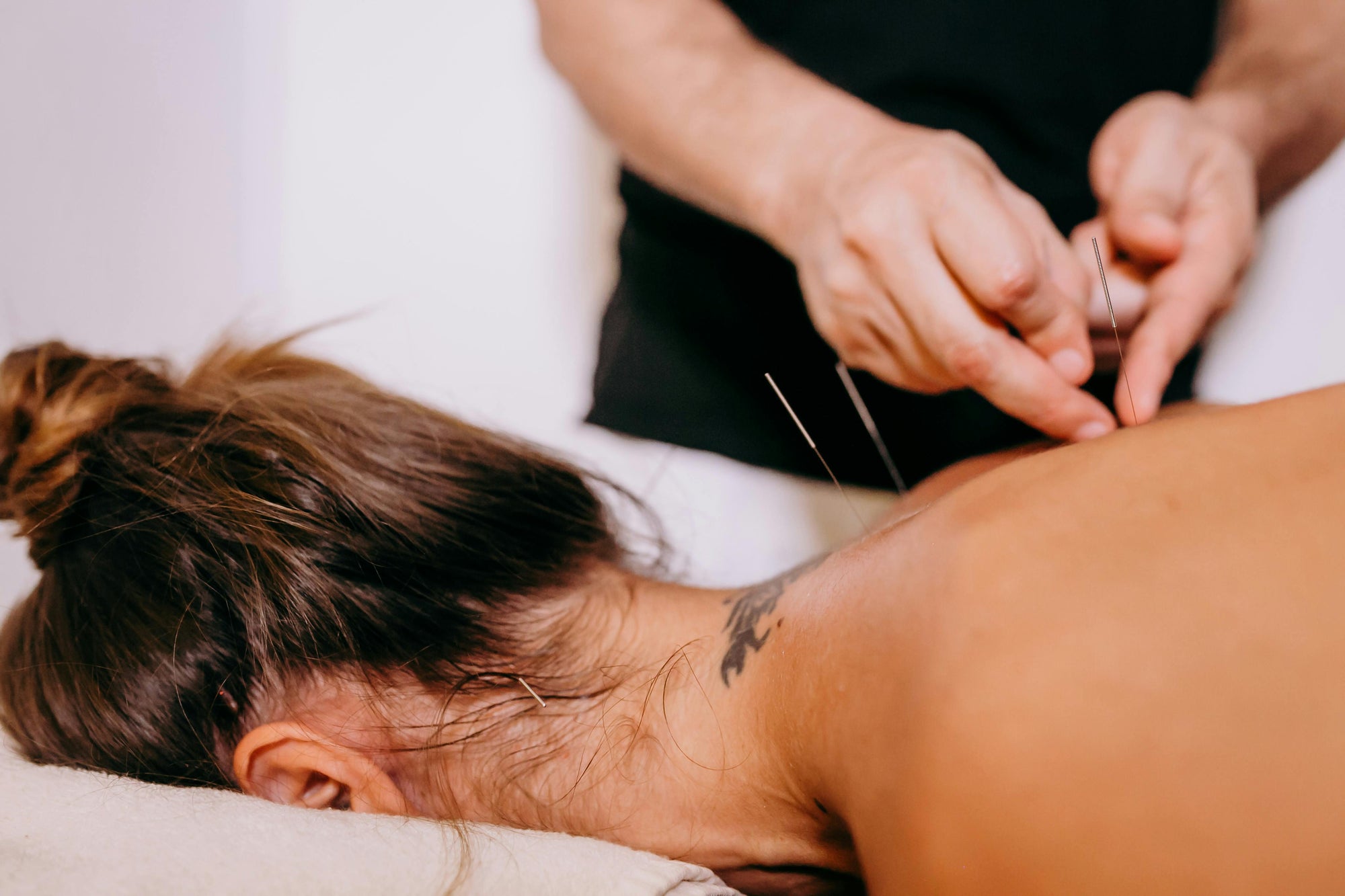 Dry needling treatment at CoreFlex Physio and Rehab Woodbridge