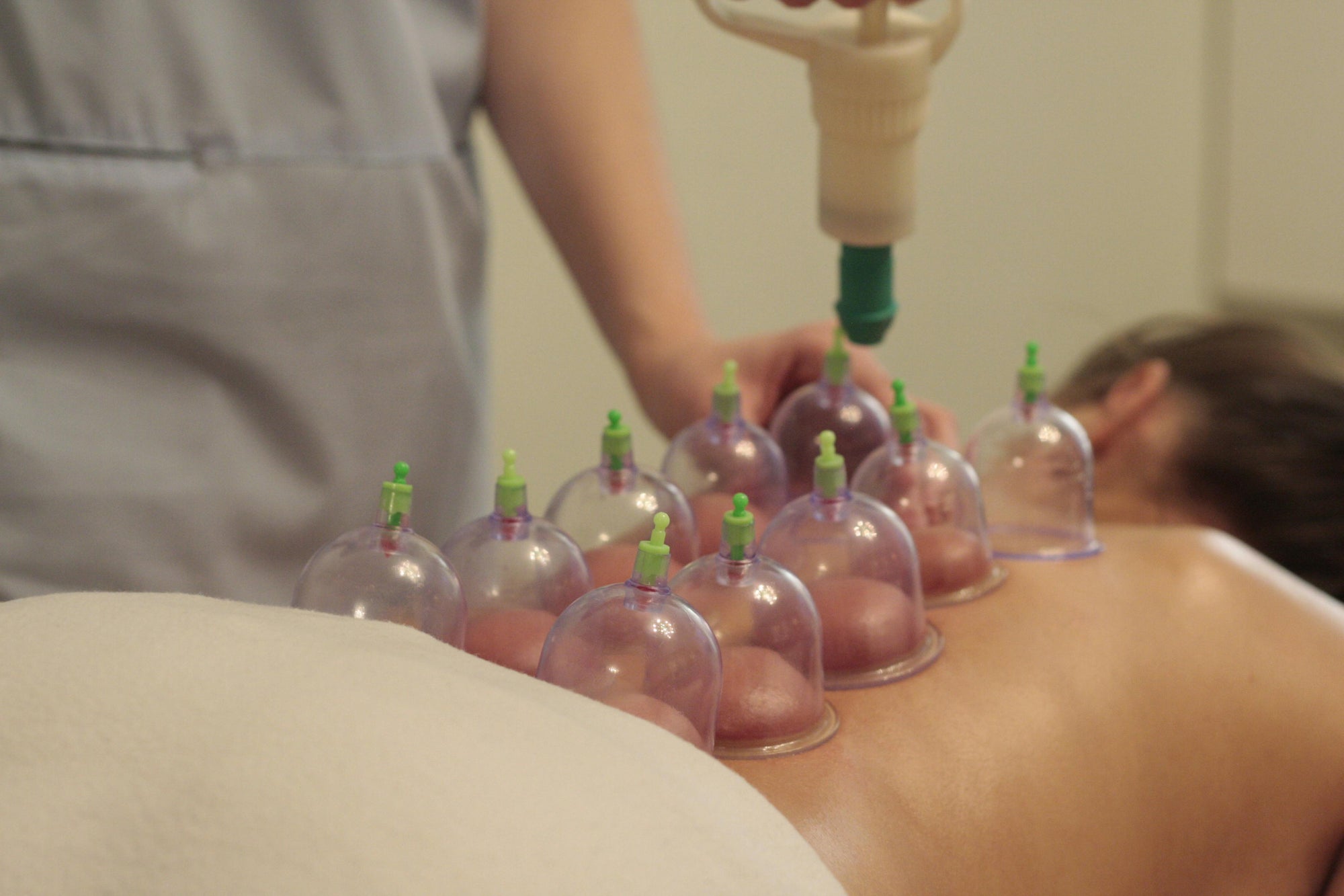Cupping therapy treatment at CoreFlex Physio and Rehab Woodbridge