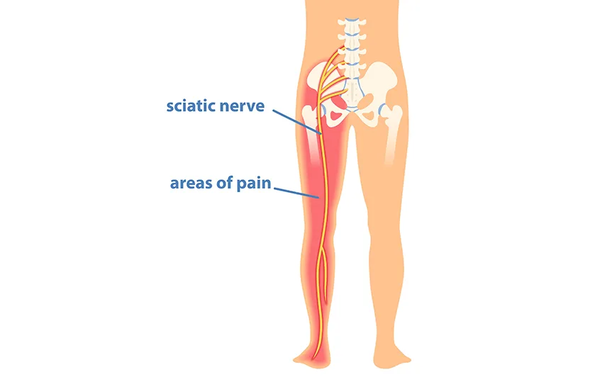 Sciatica and Nerve Pain