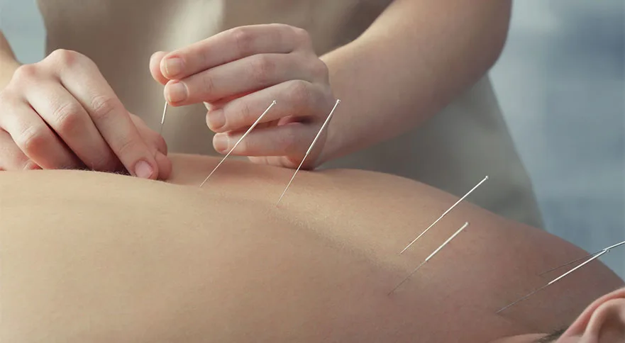 Medical Acupuncture